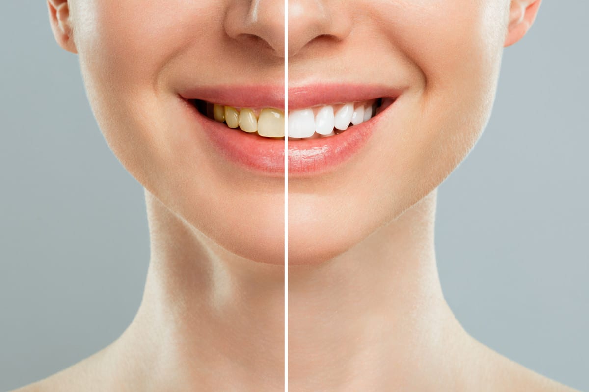 Blanchir ses dents naturellement Découvrez les meilleures astuces sans produits chimiques qui fonctionnent vraiment
